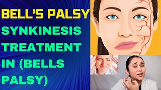 Synkinesis complete treatment in Bell’s palsy with subtitles bellspalsy synkinesis facialexercis [upl. by Lorolla]