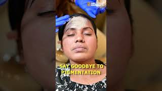 Cosmelan Peel to Treat Melasma  DrPooja Kasana [upl. by Ecirtac83]