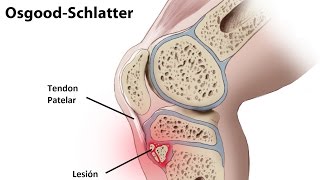 Rehabilitacion en enfermedad Osgood Schlatter [upl. by Yesteb]