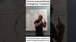 Tension pneumothorax emergency treatment shortvideo shorts drnajeeb drnajeeblectures [upl. by Enaoj]