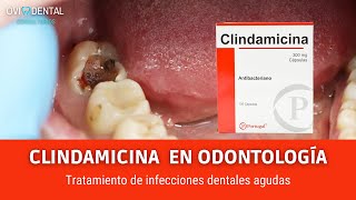 CLINDAMICINA PARA EL TRATAMIENTO DE INFECCIONES DENTALES AGUDAS [upl. by Camden]