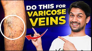 VARICOSE VEINS explained under 10 minutes  Saurabh Bothra Yoga [upl. by Erdah352]