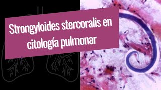 Strongyloides stercoralis en citología pulmonar [upl. by Chaunce65]