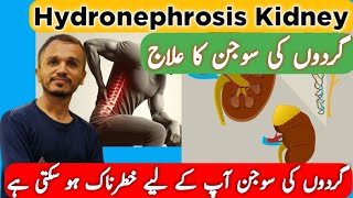 Hydronephrosis Kidney  Hydronephrosis Homeopathic Medicine  Kidney Swelling Treatment [upl. by Nevin86]