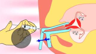 Intrauterine insemination IUI IUTPI the new method of insemination video [upl. by Randell]