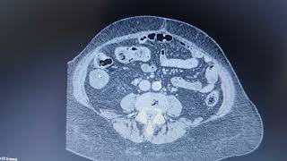 Appendiceal mucocele Radiology Short Cases [upl. by Anitnuahs633]