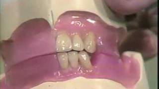 Setting Mandibular Anterior Teeth [upl. by Adlih]