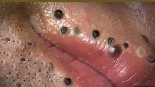 Remove Blackheads and relexing safetying 01 [upl. by Sayed]