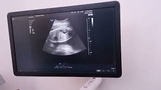 hydronephrosis with hydroureter of Rt kidney [upl. by Schultz]