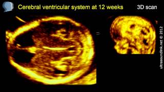 Fetal brain at 12 weeks Cerebral ventricles 3D ultrasound [upl. by Ketchan]