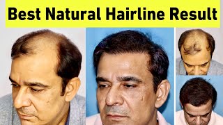 A Perfect Hair Transplant Result 4800 Graft  Most Natural Hairline in Hair Transplant History [upl. by Perron]