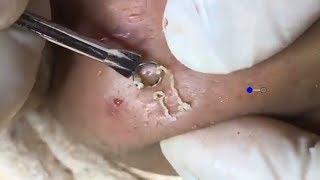 How To Remove Blackheads And Whiteheads On The Chin ✦ Dr Laelia ✦ [upl. by Ransome]