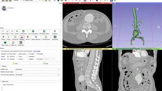 Make hollow  new segment editor effect in 3D Slicer [upl. by Narayan]