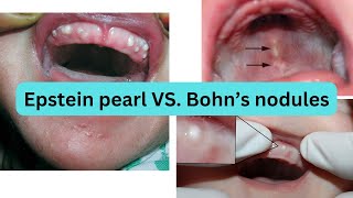 EPSTEIN PEARL vs BOHNS NODULES Whats the difference [upl. by Camfort]