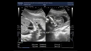 Ultrasound Video showing Hydrops fetalis Anencephaly Soft tissue edeme ascites and club foot [upl. by Maite]