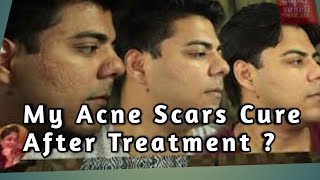 क्या Acne Scar Treatment करवाने से पिम्पल्स के गड्डे भर जाते है Conclusion of my AcneScar Treatment [upl. by Hadrian]