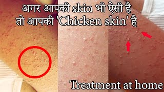 Chicken skin treatment  Alarge body solution in hindi\katha brana treatment \ keratosis pilaris [upl. by Balthazar230]