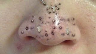 Blackhead Removal With Sac Dep Spa 1000362 [upl. by Jemmy636]