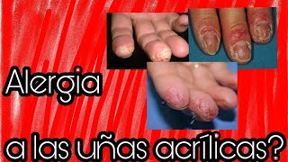 😪Alergias a las uñas acrílicas Mi experiencia👆 [upl. by Ahc]