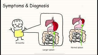 Autoimmune Lymphoproliferative Syndrome ALPS Case Study [upl. by Soloman]