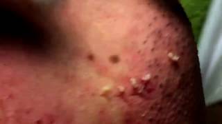 Acne Solution  Blackheads amp Whiteheads Removal 1  How to get rid of acne [upl. by Aviva487]