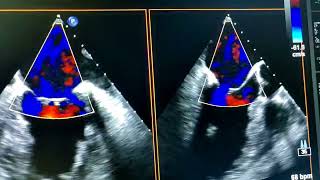 Valoración de valvulopatías mediante ecocardiograma transesofágico [upl. by Asiak998]