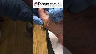 Thick callus removal by scalpel debridement in podiatry clinic [upl. by Deehahs414]