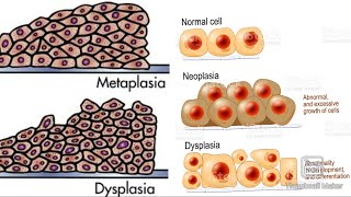 Metaplasia and dysplasia 😀 [upl. by Jari]