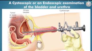 Don’t Ignore Blood in Urine Hematuria  India Medical Hub [upl. by Ayot870]