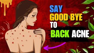 Home Remedies For Back Acne  How to Get Rid of Acne  Pimples on Back [upl. by Edals]