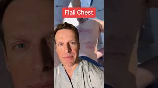 Flail chest is a potentially serious injury A flail chest are ribs broken in two or more places [upl. by Claudina]