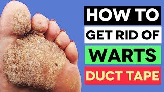 How To Safely Get Rid Of Warts With DUCT TAPE What Everyone Ought to Know [upl. by Esereht46]