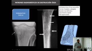 Aspectos Radiológicos de los Tumores Óseos [upl. by Atinrahc]