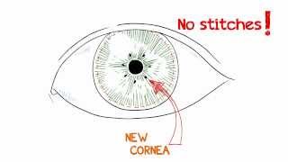 What is a Cornea Transplant [upl. by Khan199]