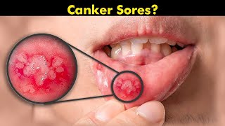 Canker Sores Symptoms Types and Treatment [upl. by Ainesej]