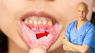 How I Quickly Healed My Canker Sore  Dr Mandell [upl. by Gardner761]