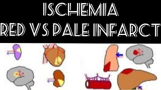 Pathology LectureIschemia Red vs Pale InfarctFrom First Aid [upl. by Chae]