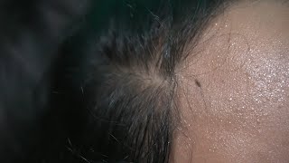 Lice and Nits Damage my Hair  Lice Popping Sounds [upl. by Aratas832]