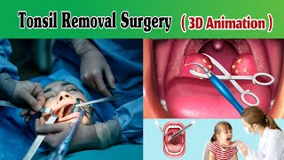 Tonsillectomy Surgery 3D Animation  Tonsillitis Surgery  Tonsils Operation [upl. by Oxley70]