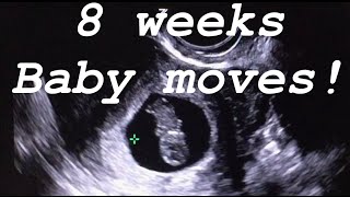 8 weeks ultrasound Baby moves [upl. by Jenni]