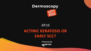 Dermoscopy Happy Hour  SEASON 2 EPISODE 15 quotACTINIC KERATOSIS OR EARLY SCCquot [upl. by Tellford40]