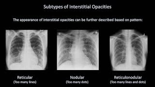 How to Interpret a Chest XRay Lesson 7  Diffuse Lung Processes [upl. by Clymer871]