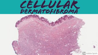 Cellular Dermatofibroma Cellular Fibrous Histiocytoma 5Minute Pathology Pearls [upl. by Shanleigh]