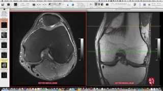 Systematic Interpretation of Knee MRI How I do it [upl. by Nomla]