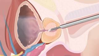 TUR Protstaat Het verwijderen van prostaatweefsel bij plasproblemen [upl. by Paulita]