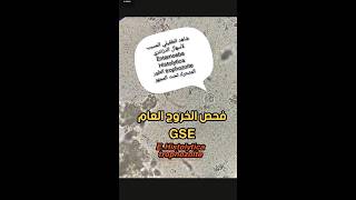 فحص الخروج Stool examination طفيلي Entamoeba Histolytica trophozoite [upl. by Ylrad]