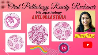 Ameloblastoma Odontogenic TumorsI Follicular PlexiformAcanthomatous Granular [upl. by Kaczer]