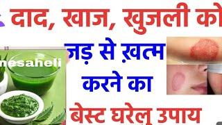 दाद खाज खुजली की 4 दिन में छुट्टी कर देगा Fungal Infection Treatment athome Daad Khaj Khujli ka ilaj [upl. by Bob577]