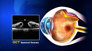 Foro maculare terapia chirurgica wwwoculisticaTVit [upl. by Frodeen]