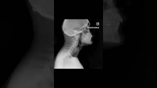 Dynamic Digital Radiography  Cervical Spine [upl. by Eilrebma296]